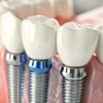 Tot ce trebuie să știi despre implantul dentar Nobel Biocare