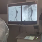 Premieră la Spitalul Județean Timișoara: prima procedură EVAR de urgență pentru un anevrism de aortă cu risc vital major