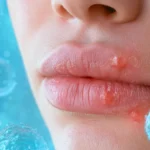 Poți „scăpa de herpes în câteva ore”? Ce spun studiile