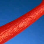 Studiu NEJM: beneficii ale terapiei antiagregante duale prelungite după stent